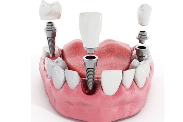 multiple teeth implants cost